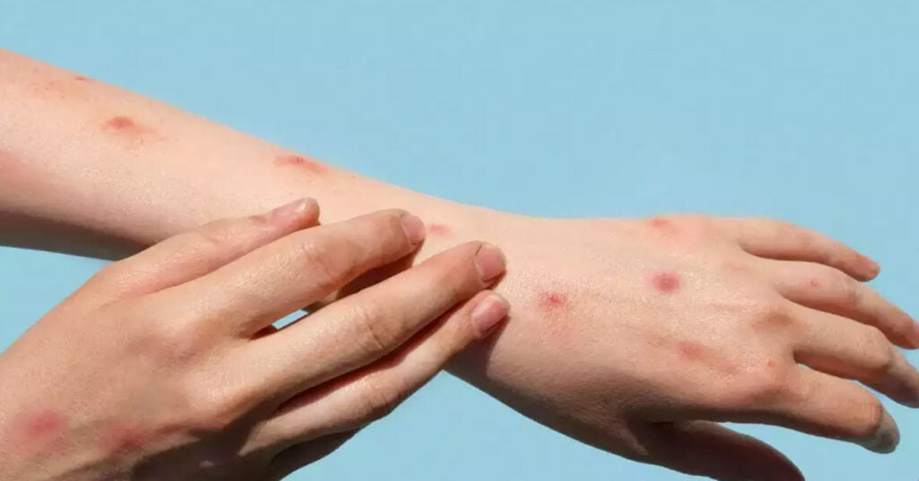 MPox Virus News 2024: कोरोना के बाद देश को मंकी पॉक्स वायरस से खतरा, आइए जाने इसके बारे में सभी जानकारी और इससे बचाव।